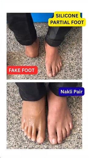 Silicone Partial Foot Prosthesis | Fake Foot Price | Artificial Foot | Nakli Pair #ossur #ampute