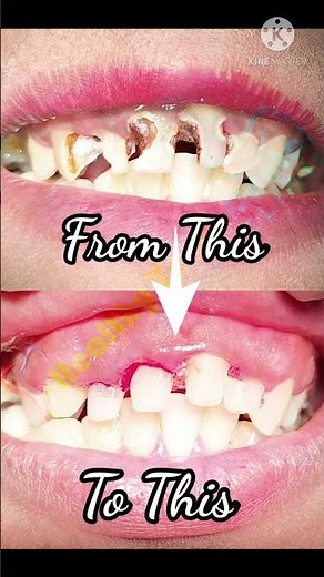 Root Canal Treatment | Teeth Reconstruction | Post and Core Build Up