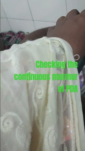 PDA/Patent ductus arteriosus, continuous murmur