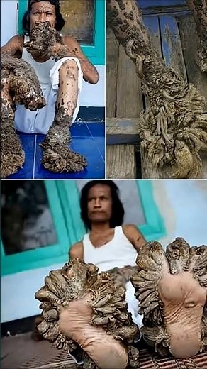 World’s Strangest Disease: Tree Man Syndrome! #medical #treeman #syndromes #notsoscary #yt #science