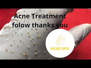 Acne spa treatment day 1