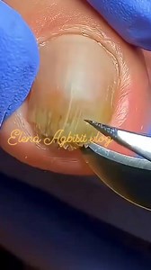 30K views · 178 reactions | Fungus #fungus #toenail #removal #elenaagbisitvlog | Elena Agbisit Vlog | Facebook