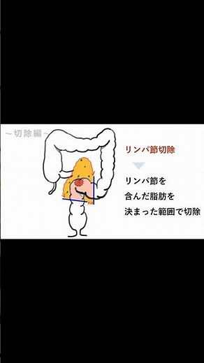 腹腔鏡下S状結腸切除の方法 ５