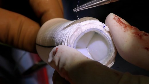 M - The Bio-Bentall procedure with concomitant hemiarch replacement through a right anterolateral minithoracotomy