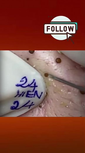 Pimple Satisfying on TikTok