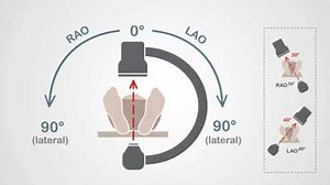 Coronary angiographic views and terms like LAO cranial or RAO caudal can sometimes be pretty confusing. But they are not that difficult after all. This short video will bring you up to speed on image intensifier basics, you will learn what the C-arm is and how it can move around in the 3-dimensional space in order to acquire the optimal image of each coronary artery and stenosis. | Dr M Jahangeer Sarwar Cardiologist