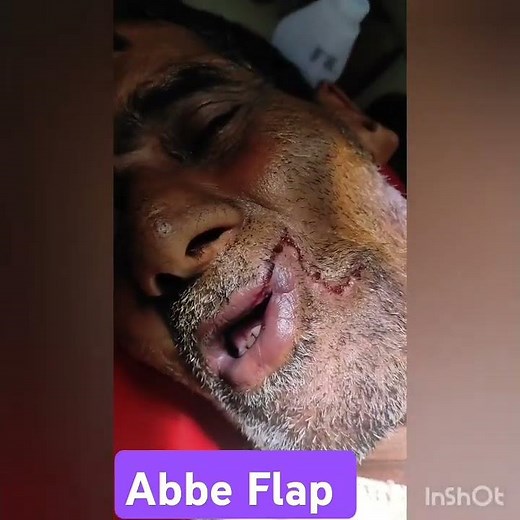 ABBE FLAP BY Dr.Robiul islam Rony