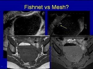 Hemorrhagic Cysts and Torsion Acute Female Pelvis