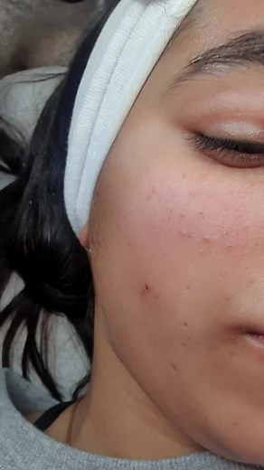 Skincare Treatment: Close-Up Pore Extraction Process