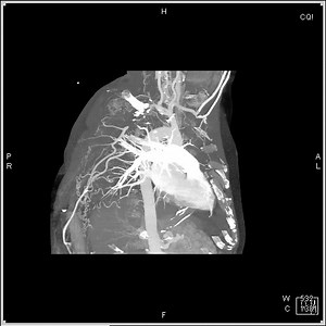 Occluded Axial and Brachial Artery | CTisus: Cutting edge information on body CT (Computed tomography).
