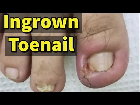Ingrown Toenail