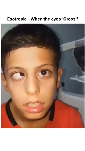 BIOLOGY | MEDICAL | HEALTH on Instagram: "Esotropia, or "crossed eyes," is a type of strabismus where one or both eyes turn inward toward the nose, disrupting binocular vision and potentially causing double vision or lazy eye (amblyopia). It can be constant or intermittent, appearing in infants (infantile esotropia) or developing later, often linked to genetics, farsightedness (accommodative esotropia), or neurological issues, and is treated with glasses, vision therapy, or sometimes surgery. Ca