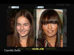 Celebrity Plastic Surgery (before and after)