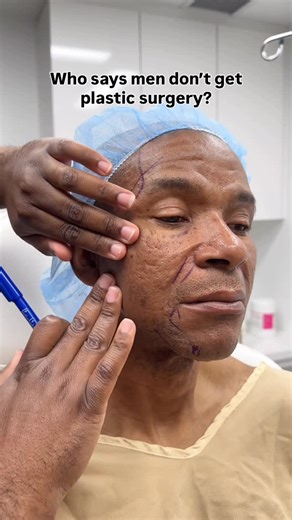 Dr. Carl Truesdale- Face Expert on Instagram: "Men want to look refreshed too! Have you ever seen a male facelift? 🤔 For this patient, I performed a #deepplanefacelift #deepplanefacelift #upperblepharoplasty #fattransferface 📲(424) 363-4112 📍 150 S. Rodeo Drive"