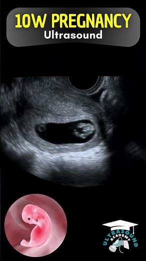 10 Weeks Pregnant: Heartbeats and First Movements Revealed!