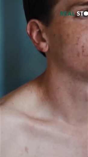 After enduring 11 major operations over 9 months to stabilize his body, a man is ready for the first operation on his mouth. His family hopes it will help rebuild his face, but it will be the first in a series of operations that could last over 2 years. Tag someone who needs to see this. #surgery #reconstruction #hospital #family #support | Real Stories