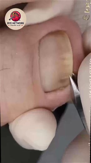 1.9K views | Simple Steps to Support Overgrown Toenails That Keep Your Nails Strong #SafeNailCare #HomeNailCare #ThickToenailCare #NailFixTips | Bye | Facebook