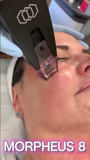 TIGHTEN & FIRM YOUR FACE AND NECK WITH MORPHEUS 8! #morpheus #morpheus8 #viralvideo