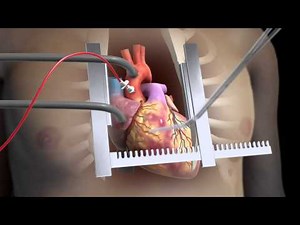 Sternotomy.mov