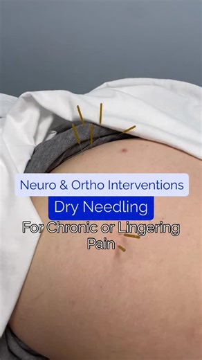 Did you know? 🤔 Dry needling is an evidence-based technique used to treat a variety of musculoskeletal conditions! ❗️Important to note about this intervention, it can benefit not only orthopedic concerns but also neurological. It’s often used when pain is lingering or limiting progress with traditional therapy. ❓How it works: A specially trained therapist inserts fine needles into trigger points within the muscle. The muscle responds with a brief contraction or “twitch” which increases blood fl