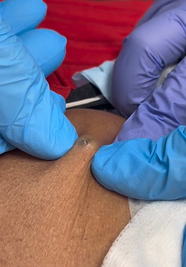 Biggest Cyst Ever Removed at Clifton Cosmetic Center