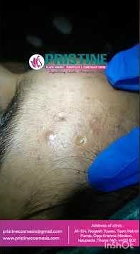Comedone Extraction Treatment | Comedone Removal | Blackhead Whitehead Removal