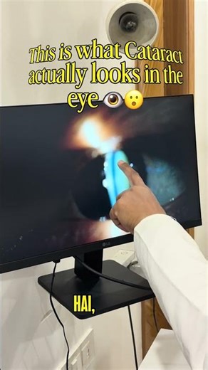 This is what cataract actually looks like inside the eye.Most people hear about cataracts.....👀