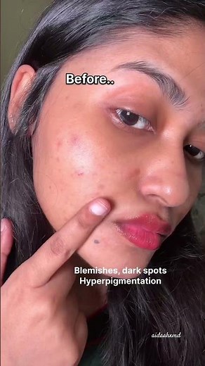 Best cream for acne and dark spots | Dr Althea 345 Relief Cream #kbeauty #acne