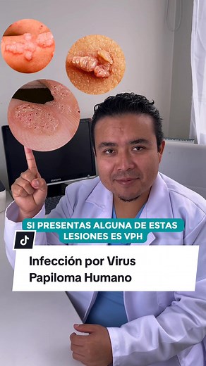 Tratamiento Integral del Virus del Papiloma Humano