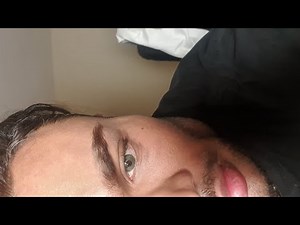 Reversal of Keratopigmentation Eye Color Change Surgery Pre-Op Brightocular