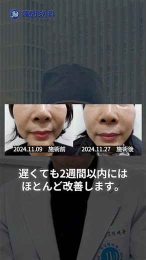 ジュブゼン施術後のあざ、いつ消える？＃ジュブゼン # 内出血 #アザ