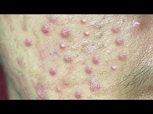 Huong Da Nang Acne Treatment #279