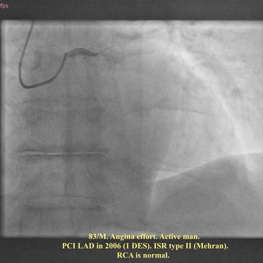 Aliyor Ganiev on Instagram: "🇬🇧 IVUS guided BioPCI in pt with ISR (19 yo Stent) type III (Waksman): Mixed pattern: Combined mechanical & biologic etiology -> treatment option-> CB, High-pressure balloon, DCB. #coronaryarterydisease #instentrestenosis #complexPCI #BioPCI #cuttingballoon #drugcoatedballoon #superhighpressureballoon #Wolverine #OPN #IVUS #IVUSguidedBioPCI Intervention Uzbekistan Sherzod Karimov Xojiakbar Toxirov Egamberdi Murtozoyev Azizbek Madaminov Kardiolog Elshod Jalolov Bost