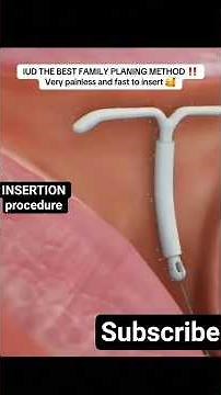 “IUD Insertion: What REALLY Happens | Step-by-Step Guide #IUD#gynecology #lhv #shorts #birthcontrol