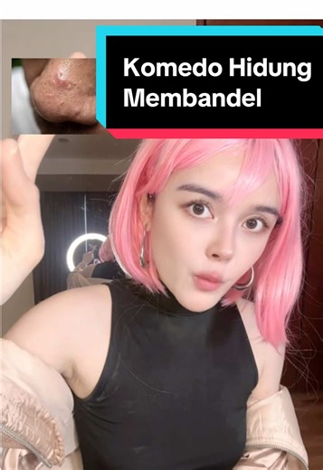 Kalo komedo hidung menahun atau membandel ga hilang2 bisa antara sebaceous hyperplasia (kelenjar minyak membesar) atau sebaceous filaments (saluran-nya membesar). Keduanya ga bahaya dan normal, ganggu secara visual saja tapi ga bisa pakai cleansing oil terus rontok ya. Harus pakai zat menekan produksi minyak dan juga keratolytic. Pake niacinamide 10% boleh, menekan minyak. Cari yang cair biar ga kinclong greasy. Boleh oot #niacinamide #ourdaylee #sebaceousfilament #sebaceoushyperplasia #komedo