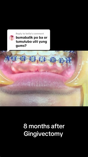 8 Months Post Gingivectomy: Key Updates and Insights