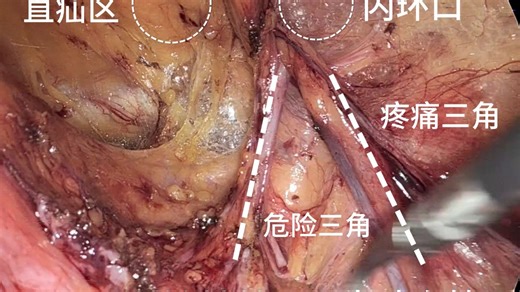 教学视频-普外科馮医生教你如何做TAPP