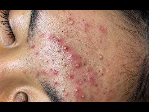 NEW 2026 - Whitehead Removal & Satisfying Pimple Extractions!#10347