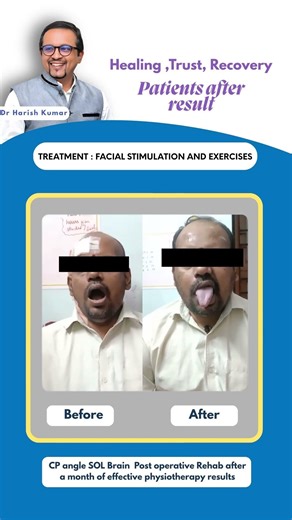 Brain Surgery Recovery Testimonial | Post Operative Rehabilitation with Exercise Therapy 🧠💪
