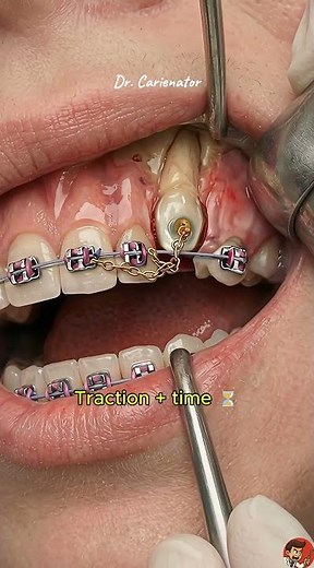 Step-by-Step: Impacted Canine Traction - Animation ⛓️✨