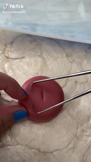 Understanding the Placement of Tenaculum on Cervix