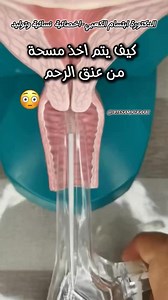 81K views · 250 reactions | PAP TEST (SMEAR)‎هو اختبار يستخدم لتشخيص التغيرات السرطانية في عنق الرحم❗️‎كل سيدة بعد عمر ال ٢٥ عاماً يجب عليها سنوياً ان تفحص بهذه‎المسحة (لتجنب سرطان عنق الرحم) | مركز ابتسام الطبي للنسائية والجلديةوالليزر والأسنان - عجمان | Facebook