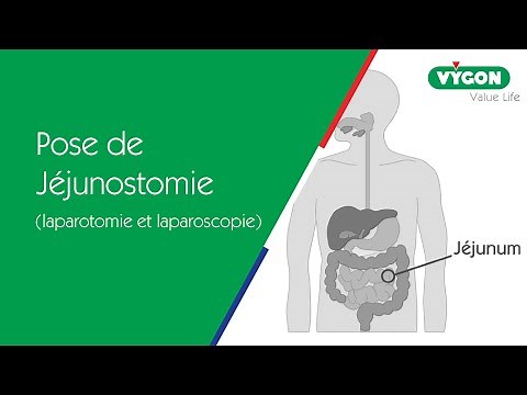 VYGON - Pose de Jéjunostomie