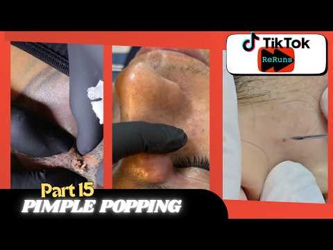 Pimple Pop 15 | Uninterrupted | TIKTOK RERUNS