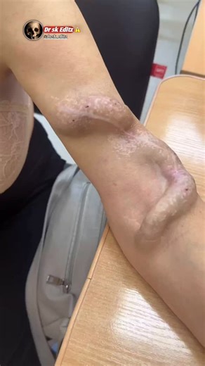 Doctor sk 👩🏻‍⚕️ on Instagram: "📌Vascular access - a patient on hemodialysis Hemodialysis is not just a procedure. It is an artificial kidney that works for the body. Vascular access is a critical element of renal replacement therapy (RRT). The effectiveness of hemodialysis, prevention of complications and the patient's quality of life depend on its type, patency and reliability. Main types of vascular access: 1. Arteriovenous fistula (AV fistula) Creates surgically, creating an anastomosis be