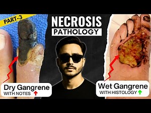 dry gangrene pathology | wet gangrene cell injury pathology | gas gangrene general pathology