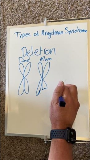 What is Angelman Syndrome?