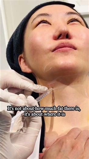 v-olet injection korea, #kbeauty #faceserumforoilyskin #fat #fatdissolving