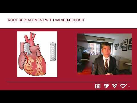 Surgery for Sporadic Aortic Aneurysms of the Aortic Root and Ascending Aorta