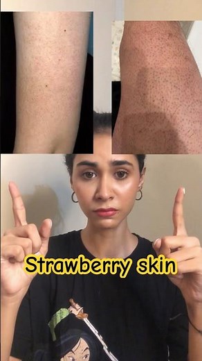 How to treat Strawberry Skin? | keratosis Pilaris